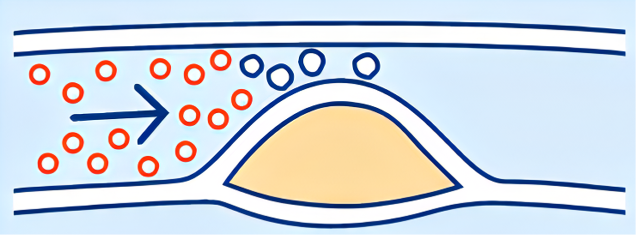 plague (fatty tissue)